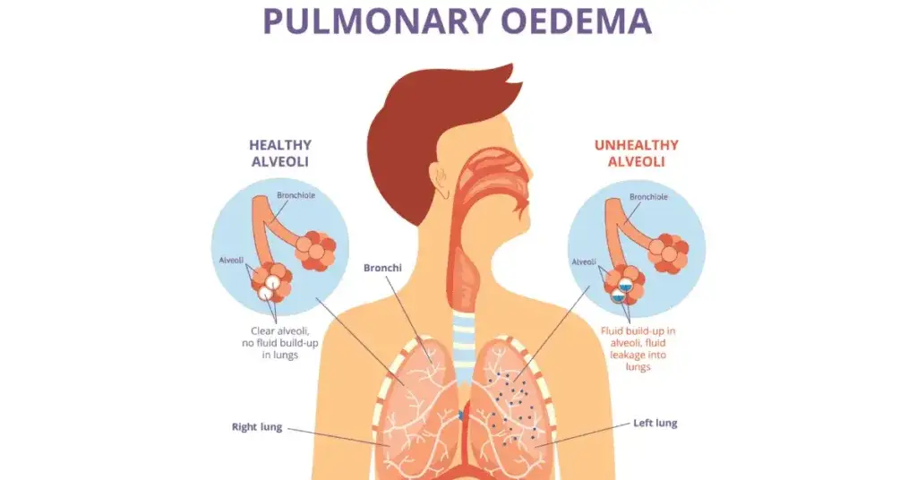 Fluid filled lungs; causes and treatment