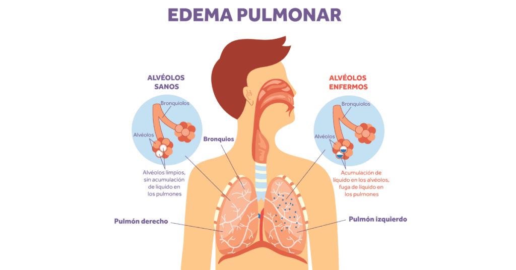 edema pulmonar spanish header Armstrong Medical | Medical Device Manufacturer