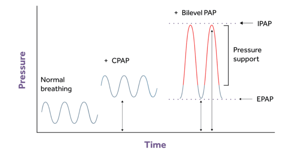 Diagaram showing the difference between CPAP and BiLevel