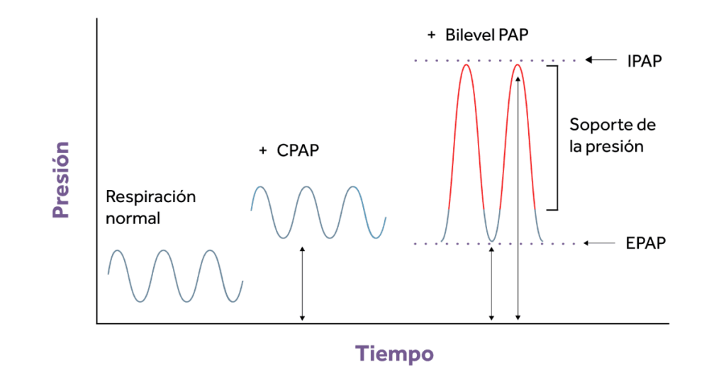 ¿Una o dos presiones?: las diferencias entre la CPAP y la PAP binivel