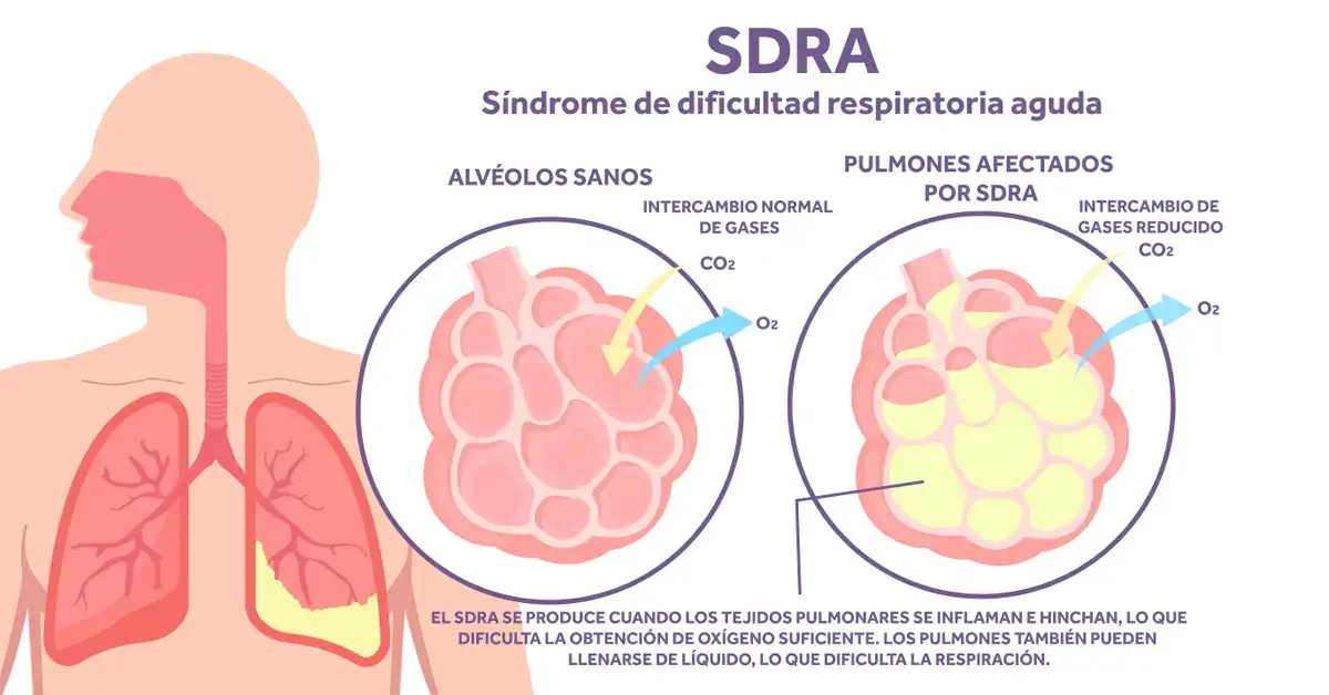 Guía de The Critical Care Practitioner sobre el SDRA: rasgos y tratamiento