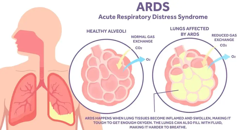 Infographic of the effects ARDS has on the lungs