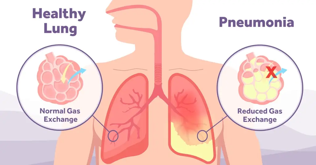 Illustration explaining the difference between a health lung and a lung suffering from pneumonia